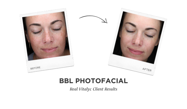 BBL Photofacial Before and After photos