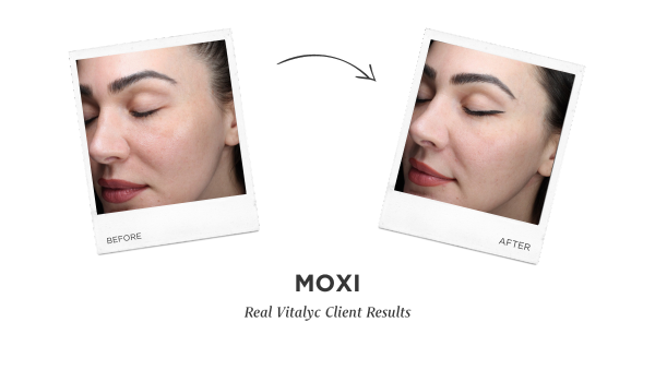Moxi Laser Before and After photos