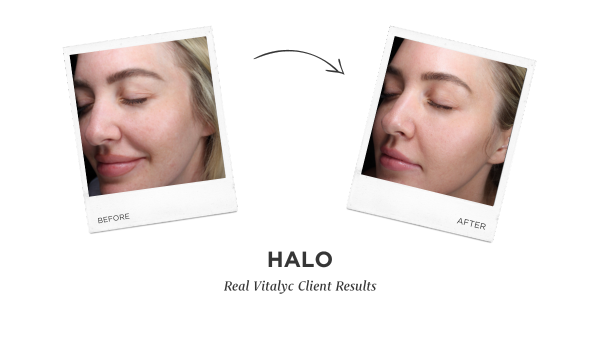 Halo Laser Before and After photos