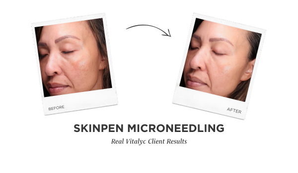 SkinPen Microneedling Before and After photos
