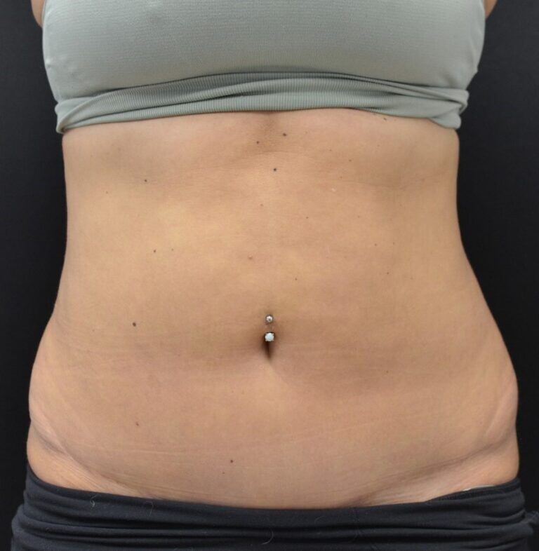 COOLSCULPTING-flanks-c07-b1-768x786