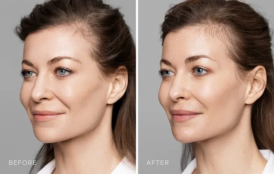 Enhancing Lips Safely And Naturally With Natural Lip Fillers