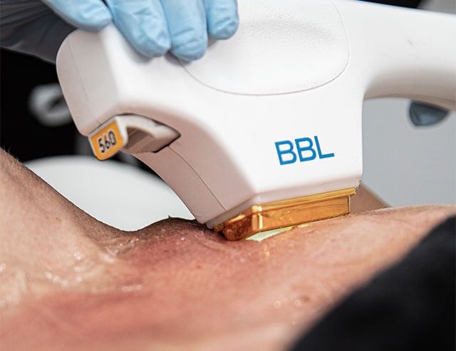 Close up photo of BBL light based treatment on skin.