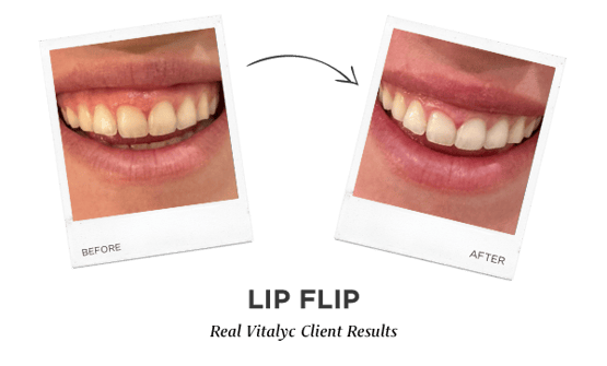 Lip Flip with Botox at Vitalyc Medspa