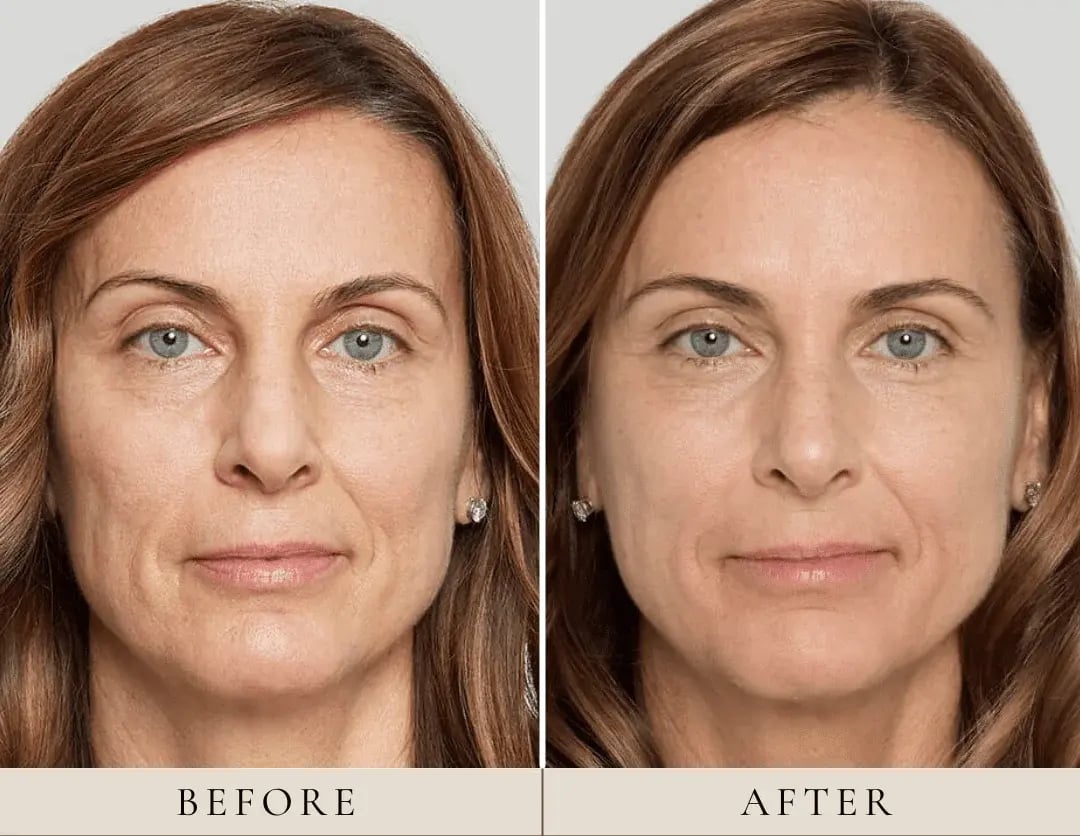 before-and-after-sculptra-treatment-medical-spa-solon-ohio-oh-eurolookmedspa